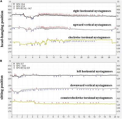 The 3D characteristics of nystagmus in posterior semicircular canal benign paroxysmal positional vertigo